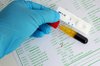 HIV and Hep C Rapid Testing